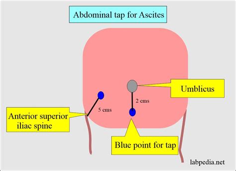 Fluid Analysis:- Part 4 - Ascitic fluid, Peritoneal tap, abdominal paracentesis, abdominal tap ...