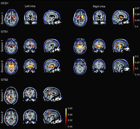 Reconstructed Eeg Source Dynamics Are Correlated With Actual