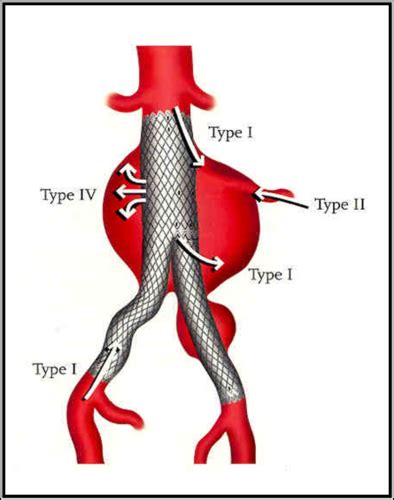 Peripheral Vascular Flashcards Quizlet