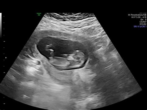 A Boy Or Nub?! 12 Week Ultrasound August 2023 Babies Forums, 45% OFF