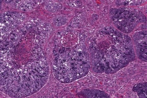 Acinic Cell Carcinoma Of The Salivary Glands Ottawa Atlas Of Pathology