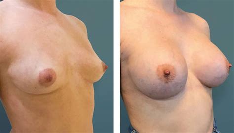 Breast Augmentation Photos Providers Cost Belorens