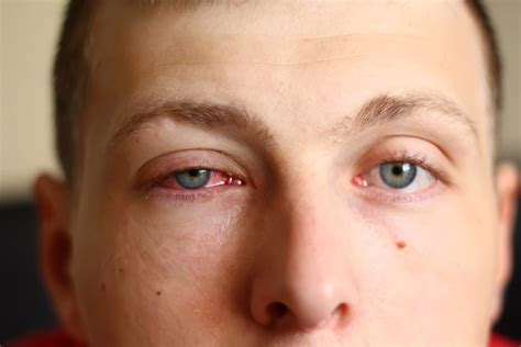 Conjuntivitis Papilar Gigante Causas Y Tratamiento Blog De Clínica