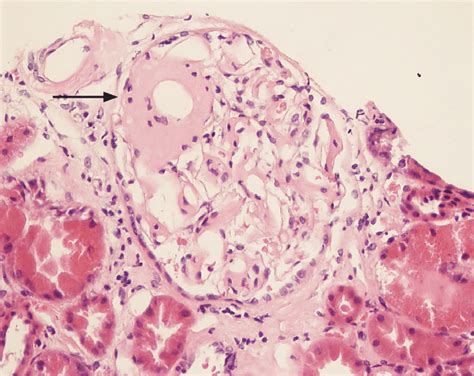 Aa Amyloidosis In Patient With Rheumatoid Arthritis Glomerulus And