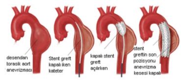 Ntratorasik Aort Anevrizmas Ve Diseksiyonlar