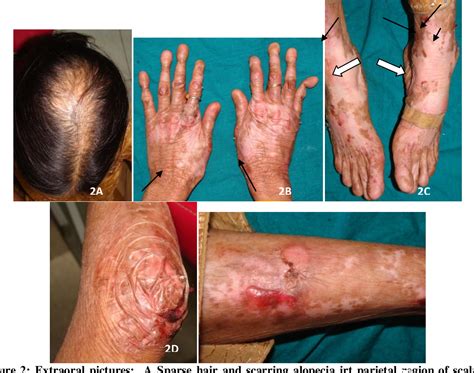 Figure 1 From Role Of Oral Lesions In Diagnosing Generalised Recessive Dystrophic Epidermolysis