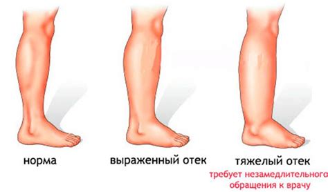 С чем связана отечность ног и лечение
