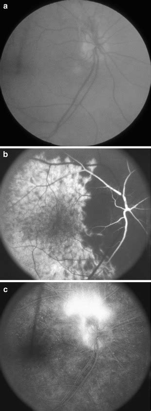 Ocular Ischemic Syndrome | Ento Key