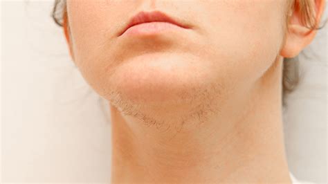 How To Treat Facial Hair From Pcos At Anne Suzanne Blog