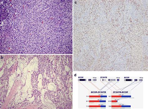 Bcor Rearranged High Grade Endometrial Stromal Sarcoma A The Tumors