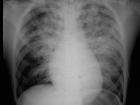 Pulmonary Edema On Chest X Ray Porn Sex Picture