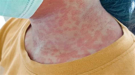 Viral Rash Types Symptoms And Treatment In Adults And Babies