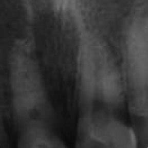 Periapical Radiograph Showing Incomplete Root End Development And