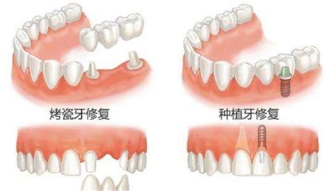 单颗牙缺失怎么修复好？——广州德伦口腔