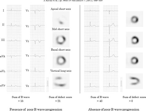 Table 1 From Poor R Wave Progression And Myocardial Infarct Size After