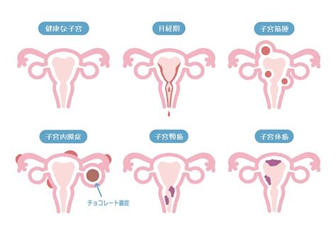 子宮筋腫・子宮内膜症・子宮腺筋症｜大阪市中央区のラ・クォール本町クリニック