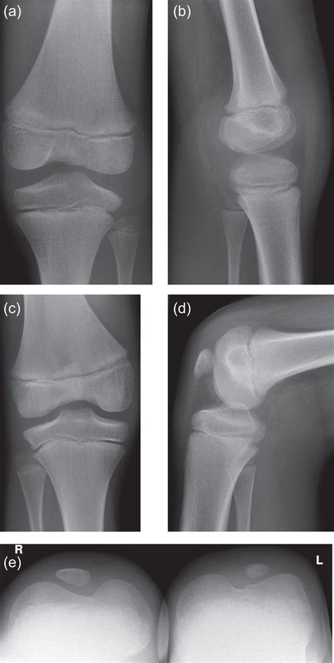 Nail Patella Syndrome Knee