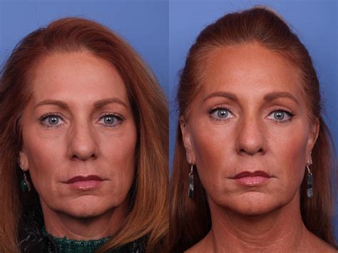 Blepharoplasty Before And After Pictures Case 493 Scottsdale