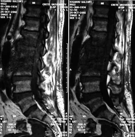 -MRI showing the epidural abscess pre op | Download Scientific Diagram