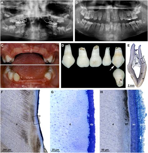 Frontiers Malformations Of The Tooth Root In Humans