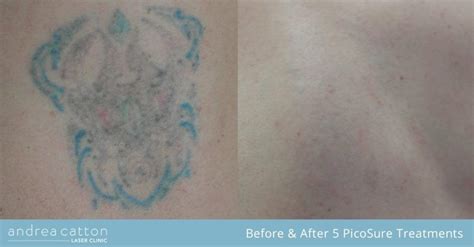 dermabrasion tattoo removal before and after - diers-annon