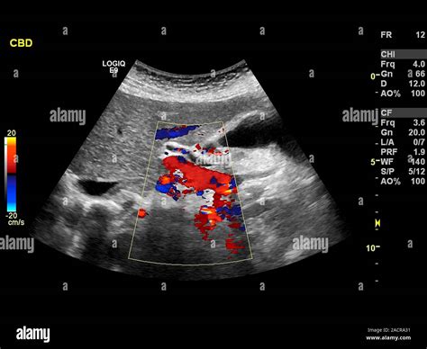 Gallstones Doppler Ultrasound Scan Of The Gallbladder Of A 86 Year Old