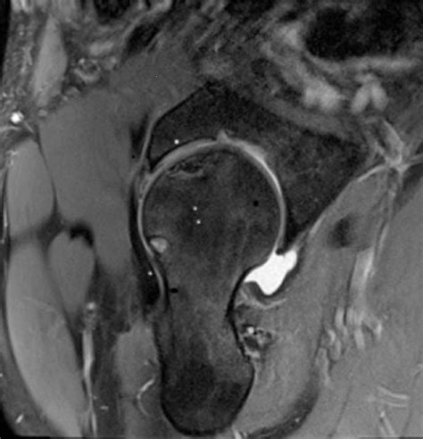 On This T Weighted Axial Magnetic Resonance Imaging Cut An