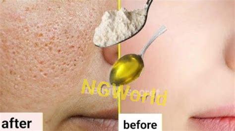 In Just 3 Minutes Shrink Large Open Pores Permanently Get Rid Of Open Pores At Home Recipe