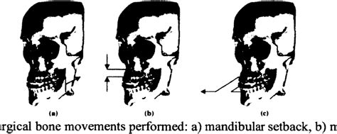 Figure 3 From Development And Validation Methodology Of The Nuss