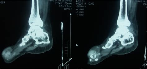 Pathology Outlines Gout And Gouty Arthritis