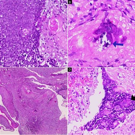 H E Stain A D Microscopic Images Of Pilomatrixoma A Lobular