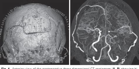 A Case Of One Staged Cerebral Revascularization For Hemodynamic