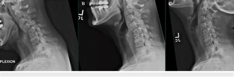 Flexion A Neutral B And Extension C Cervical Spine X Rays Show Download Scientific