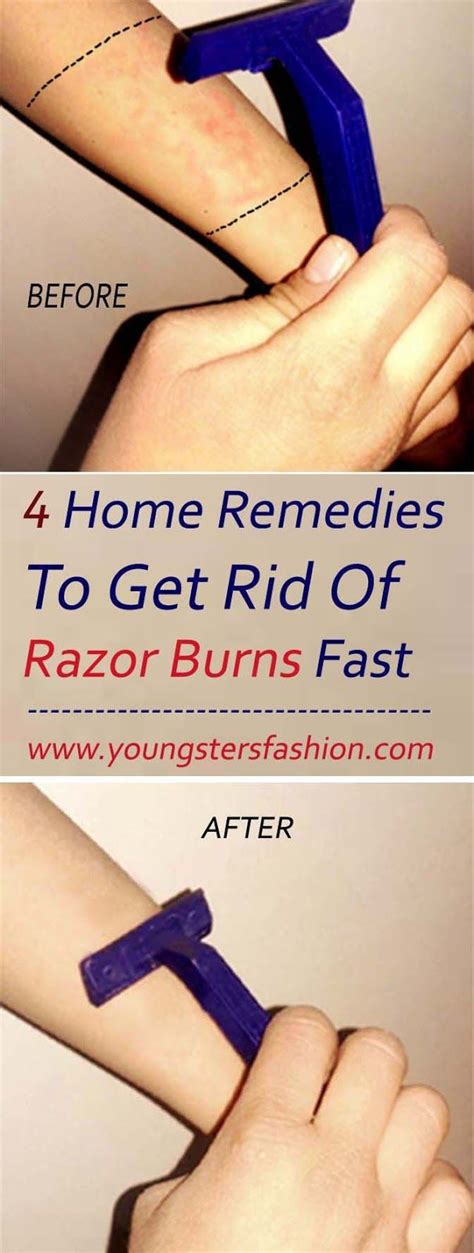 Get Rid Of Razor Burn Overnight