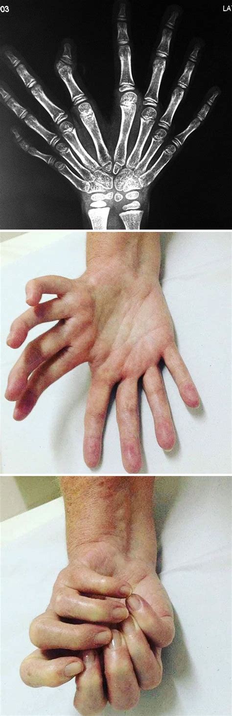 Ulnar Dimelia Or Mirror Hand Syndrome | Genetics, Human oddities, Eye ...