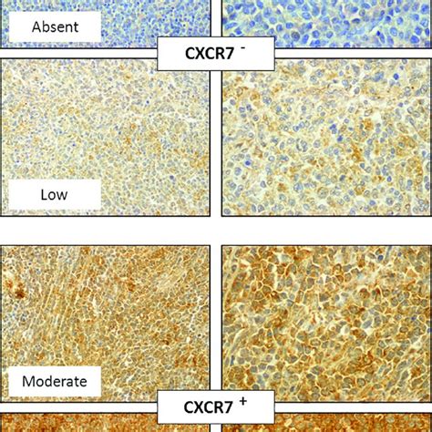 Representative CXCR7 Immunostaining Of DLBCL Tissue Sections The DLBCL