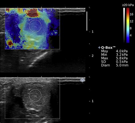 Figure From Testicular Shear Wave Elastography In Normal And