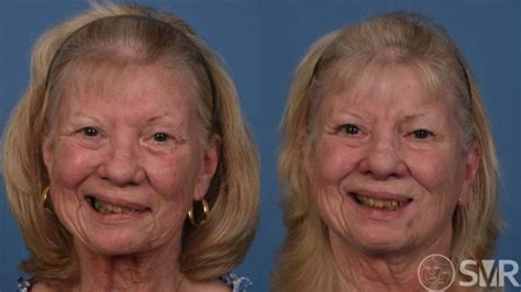 Bells Palsy Before And After Photo Gallery Dallas Tx Shai M Rozen Md Facs