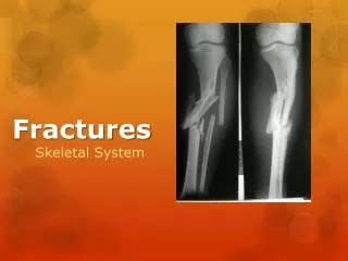 Ppt Fractures De La Diaphyse Femorale Powerpoint Presentation Free