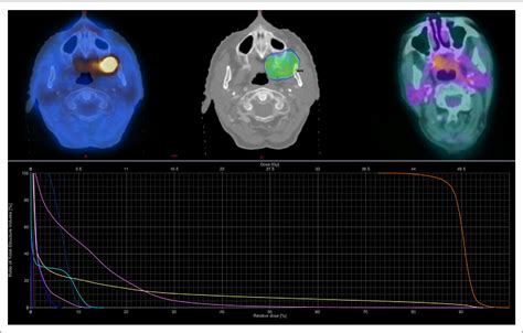 Figure 1 from Stereotactic Body Radiotherapy as Primary Treatment for ...