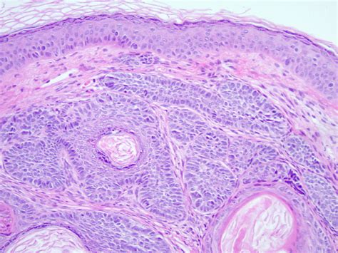 Trichoepithelioma - EyeWiki