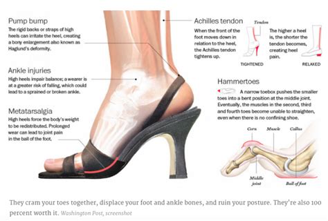 High Heel Injuries Phillyvoice