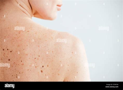 Cropped View Of Diseased And Naked Woman With Moles On Skin On White Stock Photo Alamy