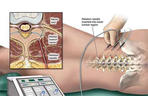 Radio Frequency Neurotomy Ablation Minnesota Institute For Pain