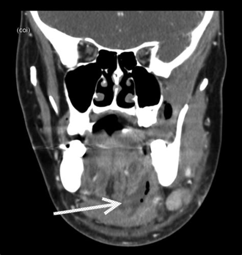 Soft Tissue Neck Ct Scan