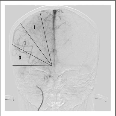 Figure From Application Of Capillary Index Score In Predicting Three