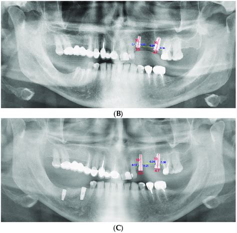 Measurement Of Periimplant Bone Loss A After Implant Placement B