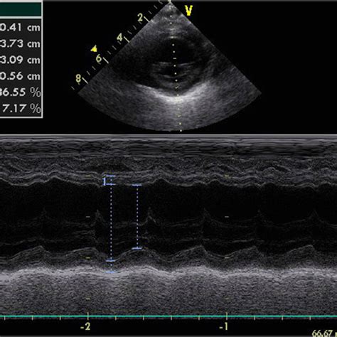 Initial Echocardiography Showing Left Ventricular Ejection Fraction Of