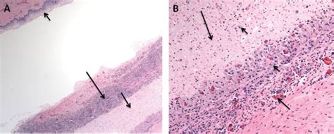 Gartners Duct Cyst Histology