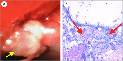 Direct bronchoscopy and lesion biopsy. (a) Bronchoscopy showing a ...